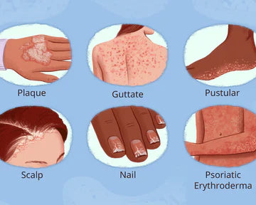 Psoriasis Support Millet packs